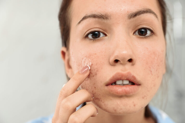 Acne Treatment - Children's Dermatology