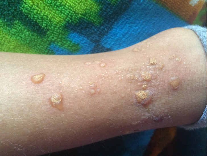 Children's Dermatology Blog - Warts And How Best to Treat Them