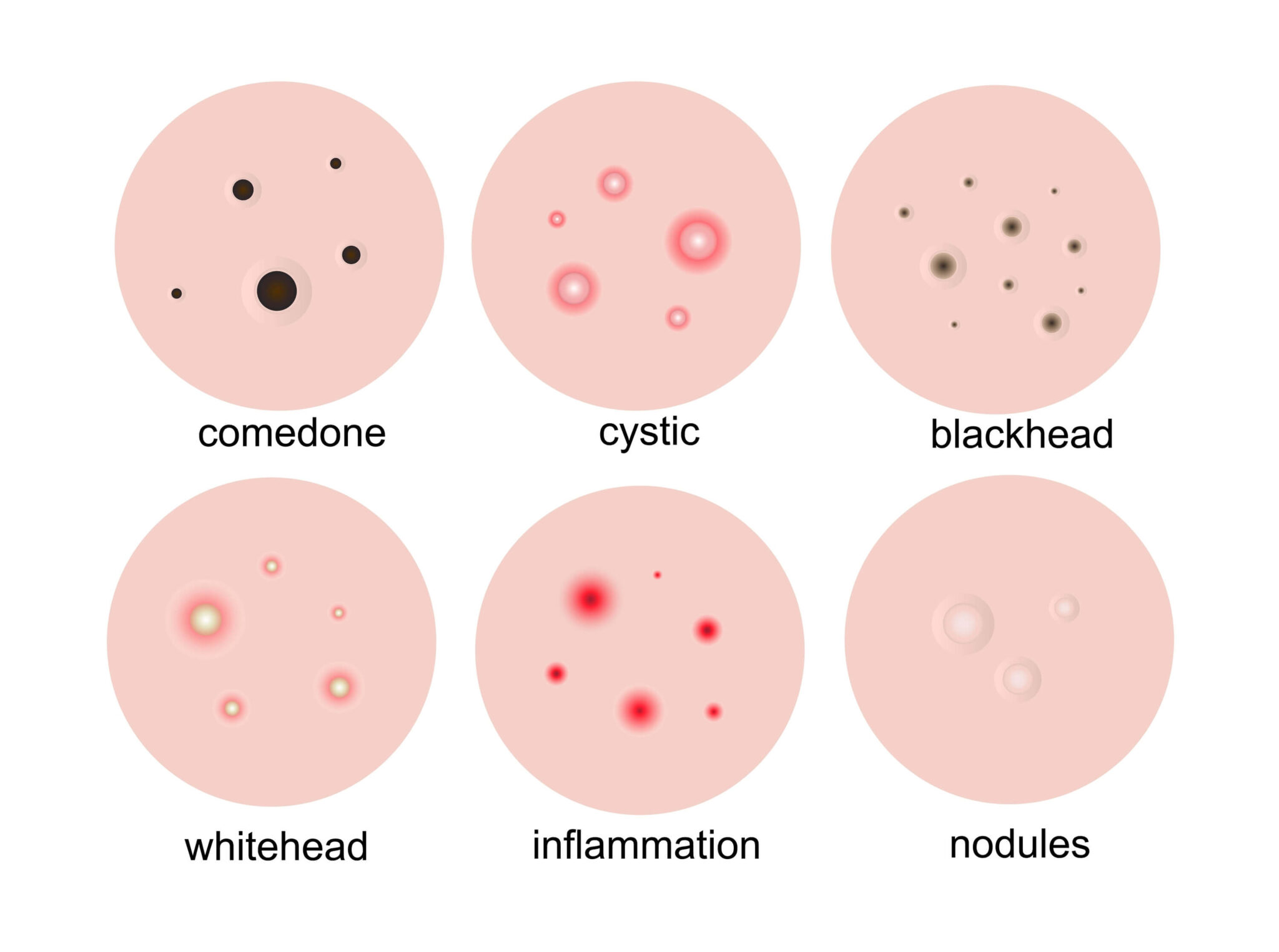 Acne: Facts, Myths and Treatment Options - Children's Dermatology