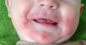 Children's Dermatology Blog - A Parent’s Guide to Atopic Dermatitis (Eczema)