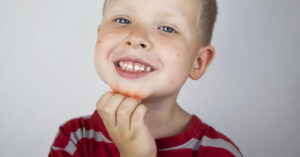 Children's Dermatology Blog - All About Hives: What They Are and What Causes Them