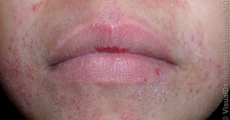 What is Perioral Dermatitis? - Children's Dermatology