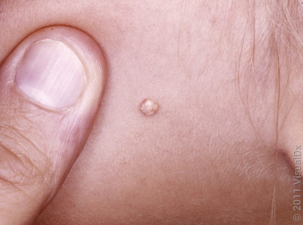 Molluscum Contagiosum lesions_Children's Dermatology Orange County, CA