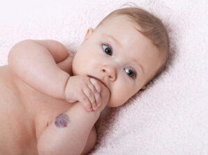 Hemangiomas and blood vessel tumors - Children's Dermatology Blog