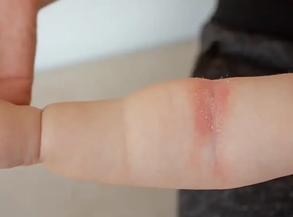 Pediatric atopic dermatitis treatment in Orange, CA